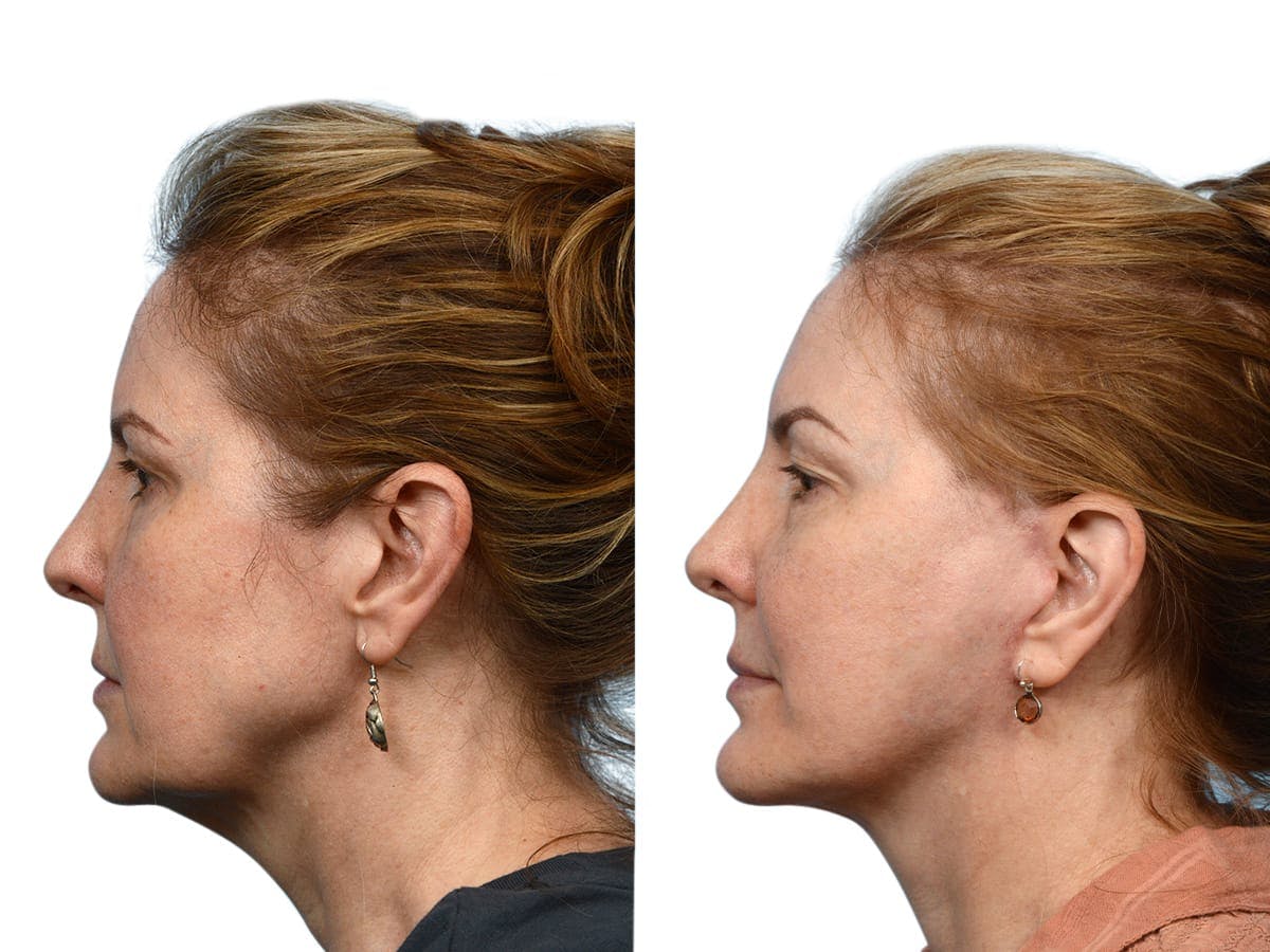 Facelift Before & After Gallery - Patient 212905 - Image 3