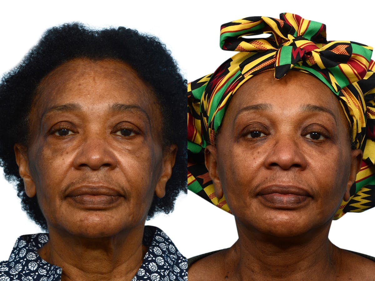 Facelift Before & After Gallery - Patient 313848 - Image 1