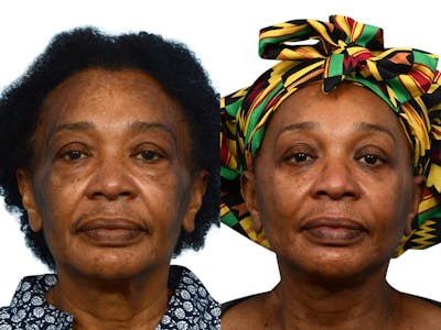 Facelift Before & After Gallery - Patient 313848 - Image 1