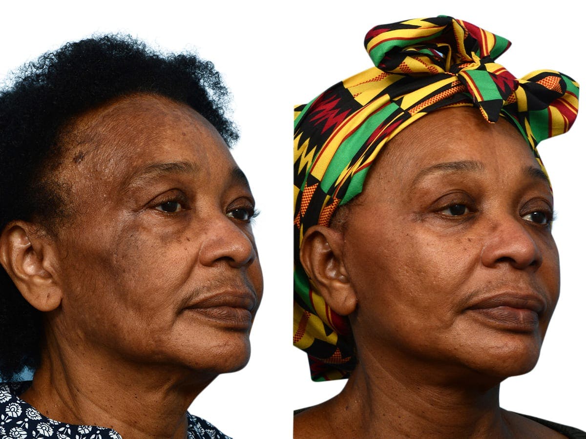 Facelift Before & After Gallery - Patient 313848 - Image 3