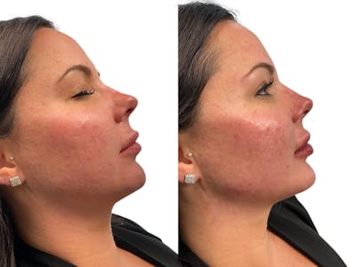 Facelift Before & After Gallery - Patient 537531 - Image 1