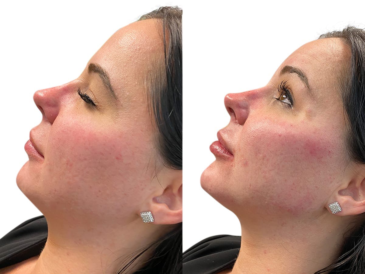 Facelift Before & After Gallery - Patient 537531 - Image 2