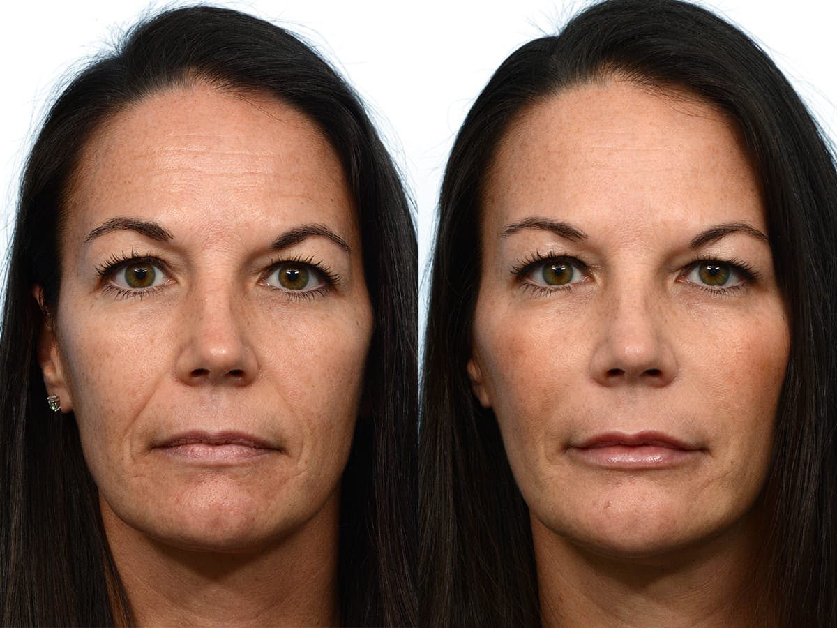 Facelift Before & After Gallery - Patient 205713 - Image 1