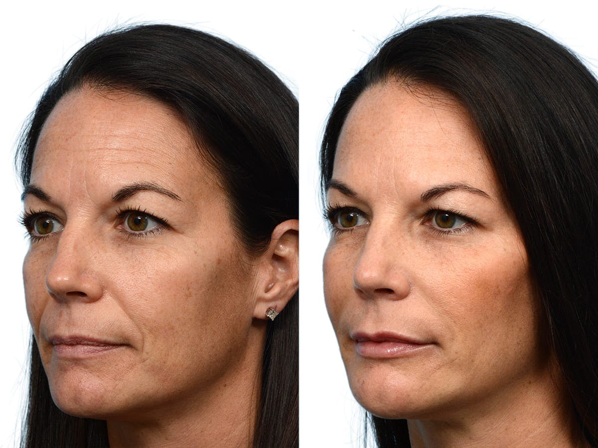 Facelift Before & After Gallery - Patient 205713 - Image 2