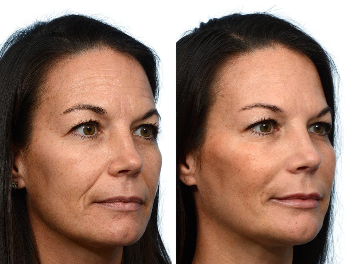 Facelift Before & After Gallery - Patient 205713 - Image 3