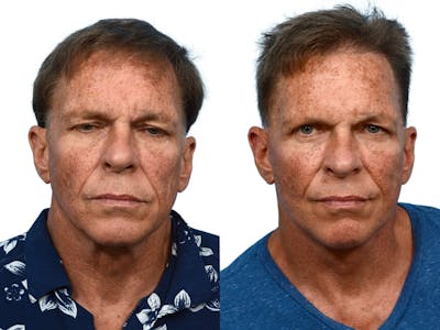Facelift Before & After Gallery - Patient 161194 - Image 1