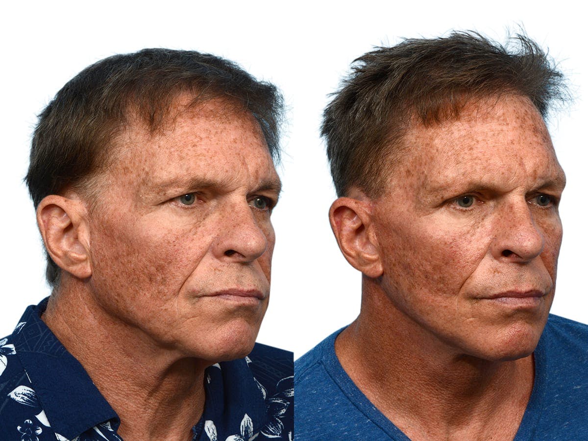 Facelift Before & After Gallery - Patient 161194 - Image 2