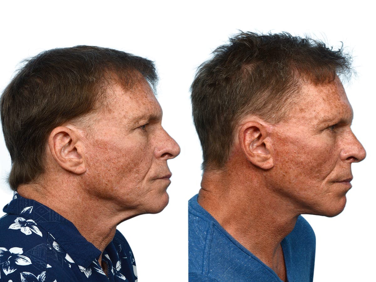 Facelift Before & After Gallery - Patient 161194 - Image 3