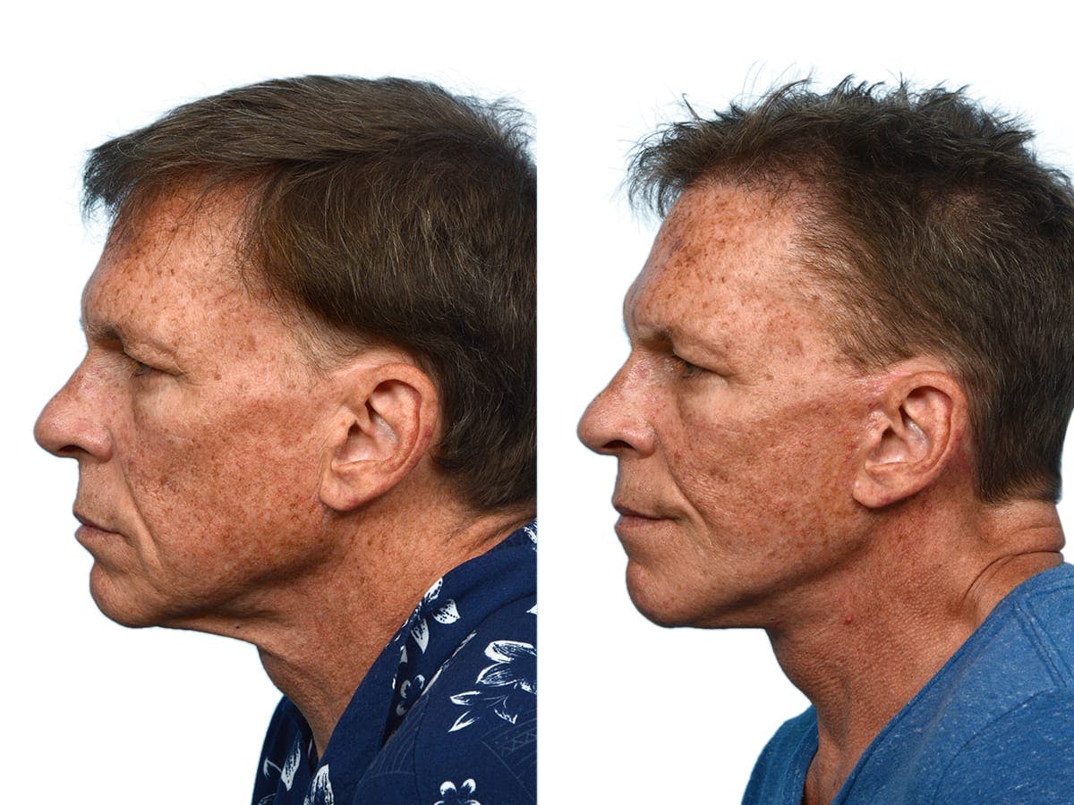 Facelift Before & After Gallery - Patient 161194 - Image 4