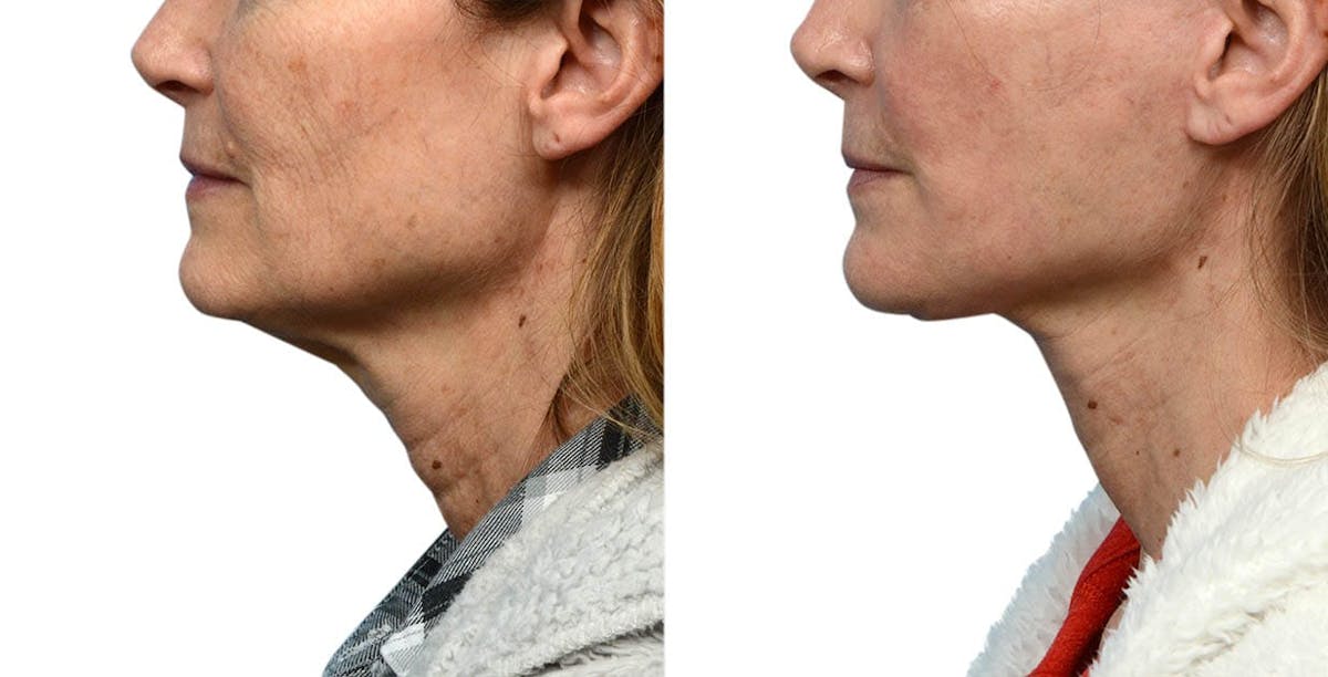 Facelift Before & After Gallery - Patient 176747 - Image 2