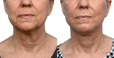 Facelift Before & After Gallery - Patient 557690 - Image 1