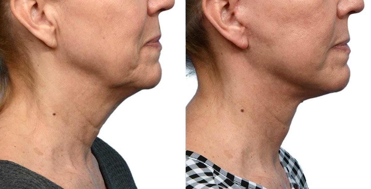 Facelift Before & After Gallery - Patient 557690 - Image 2