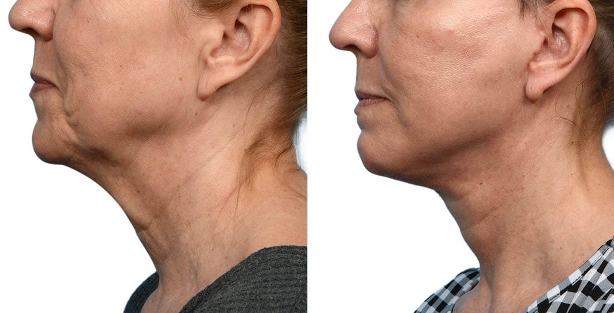 Facelift Before & After Gallery - Patient 557690 - Image 3