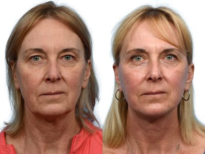 Facelift Before & After Gallery - Patient 402649 - Image 1