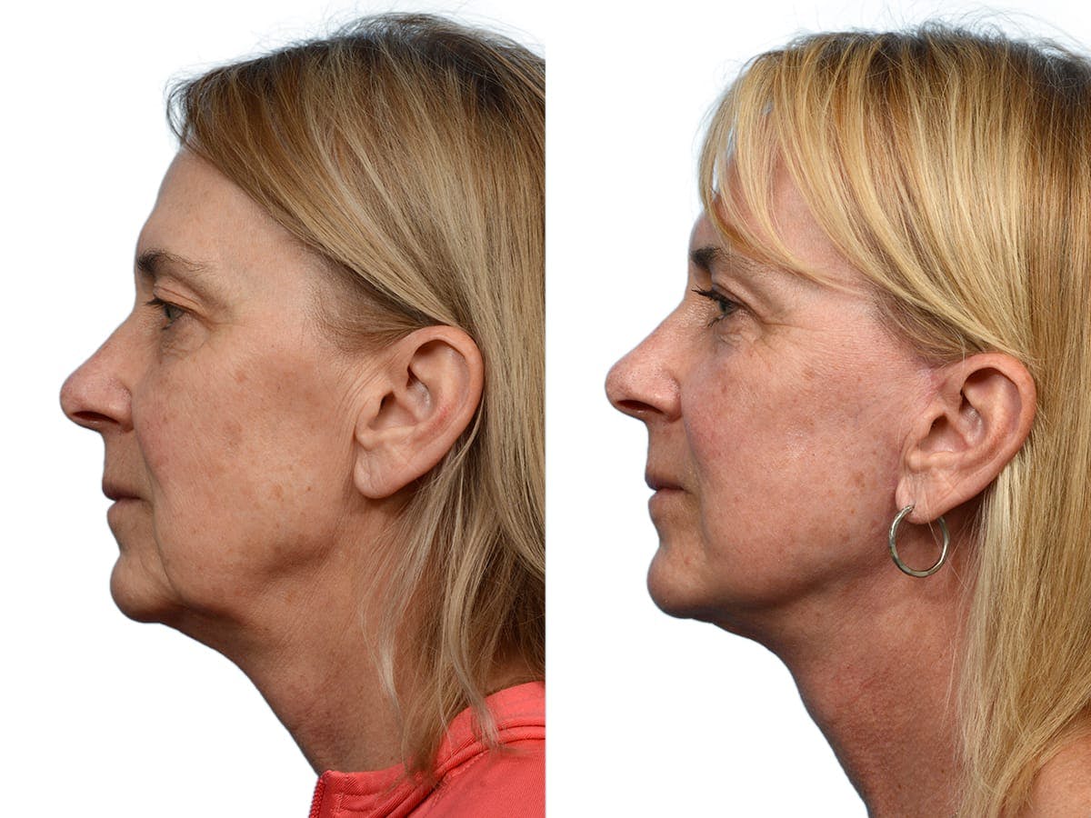 Facelift Before & After Gallery - Patient 402649 - Image 3