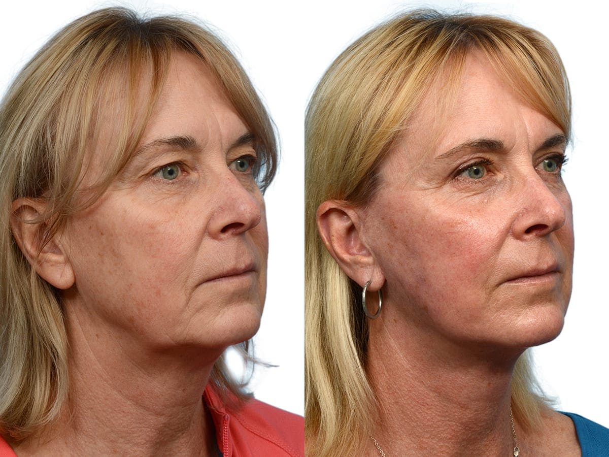 Facelift Before & After Gallery - Patient 402649 - Image 4