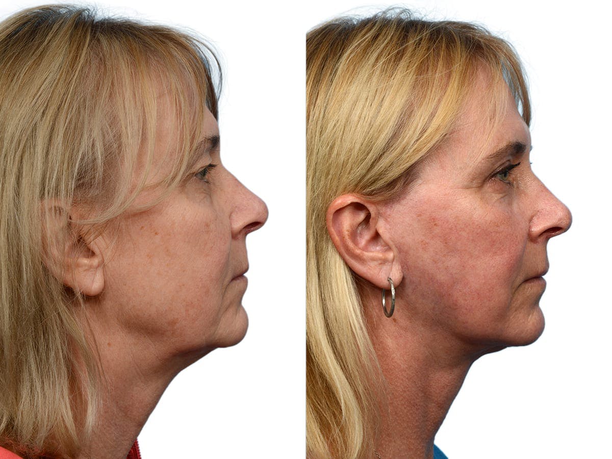 Facelift Before & After Gallery - Patient 402649 - Image 5
