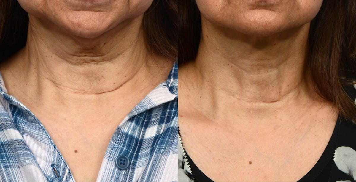 Facelift Before & After Gallery - Patient 132912 - Image 1