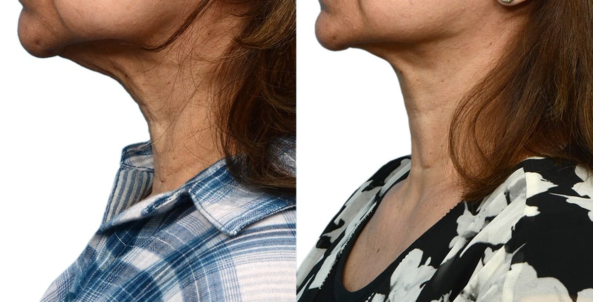Facelift Before & After Gallery - Patient 132912 - Image 2
