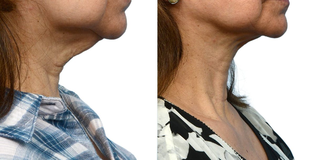 Facelift Before & After Gallery - Patient 132912 - Image 3