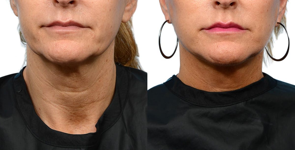 Facelift Before & After Gallery - Patient 390106 - Image 1