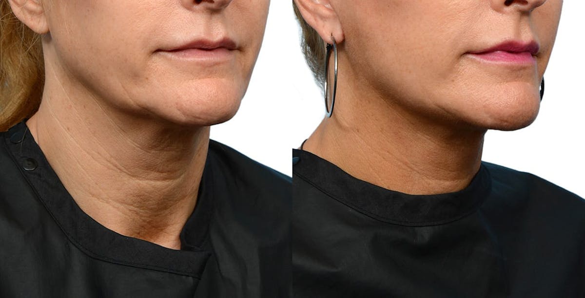 Facelift Before & After Gallery - Patient 390106 - Image 2