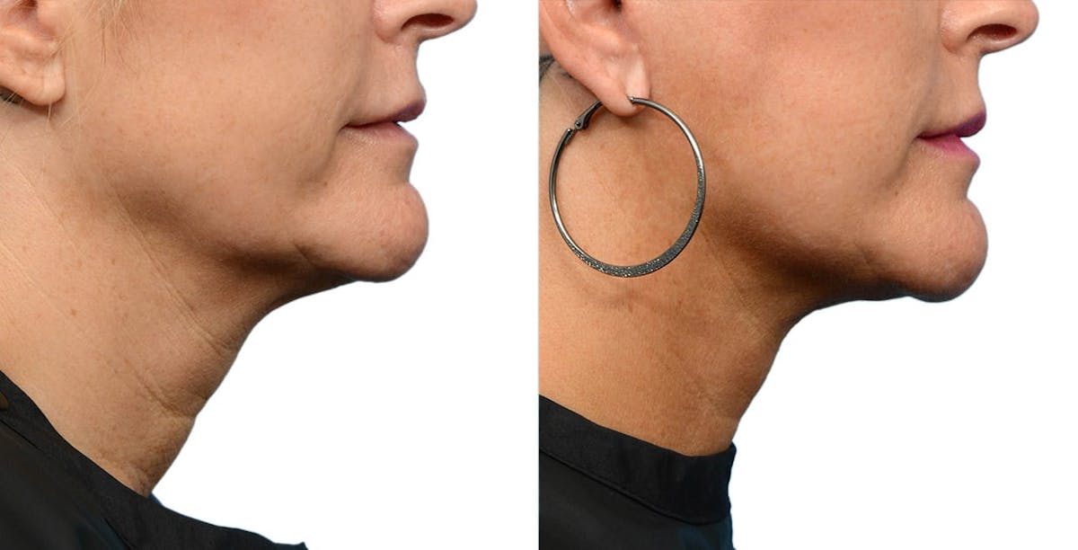 Facelift Before & After Gallery - Patient 390106 - Image 3