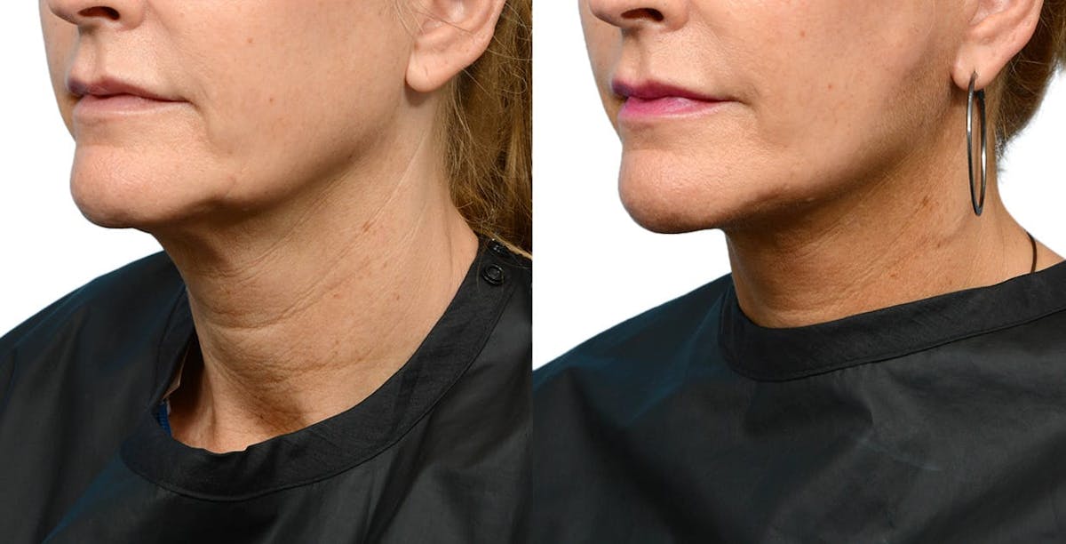 Facelift Before & After Gallery - Patient 390106 - Image 4