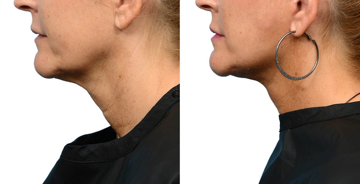 Facelift Before & After Gallery - Patient 390106 - Image 5