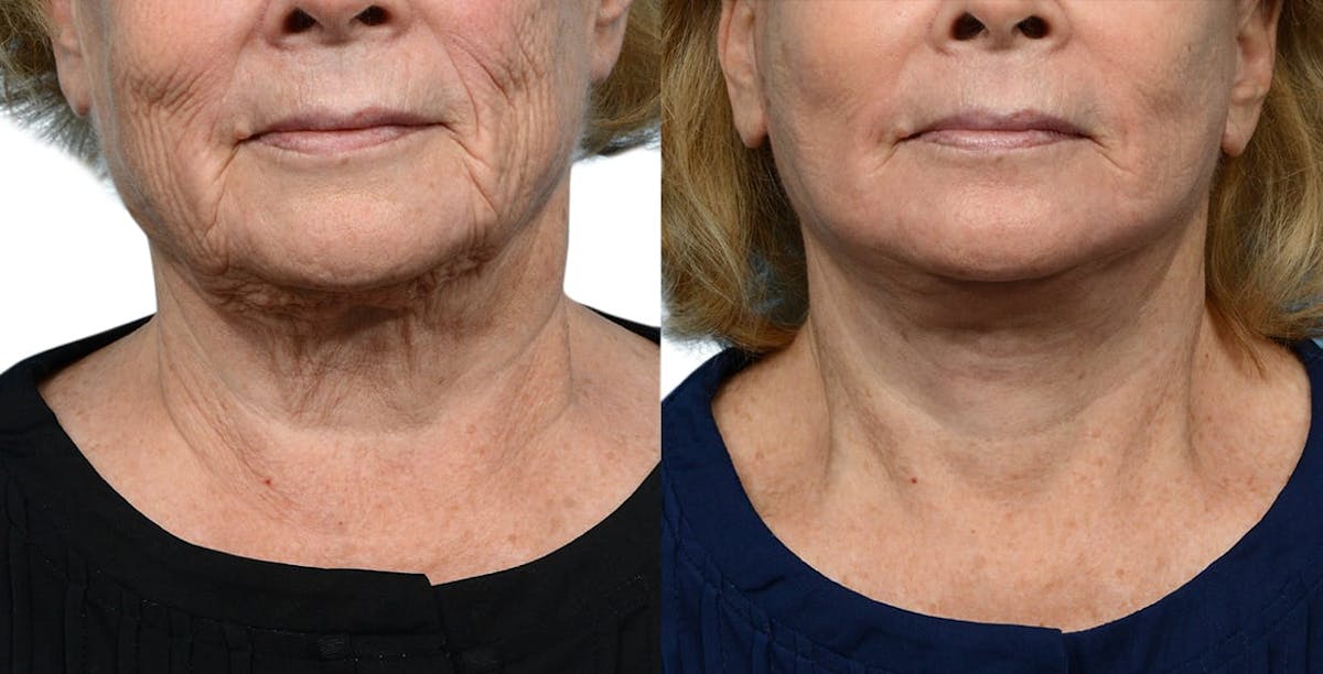 Facelift Before & After Gallery - Patient 129558 - Image 1