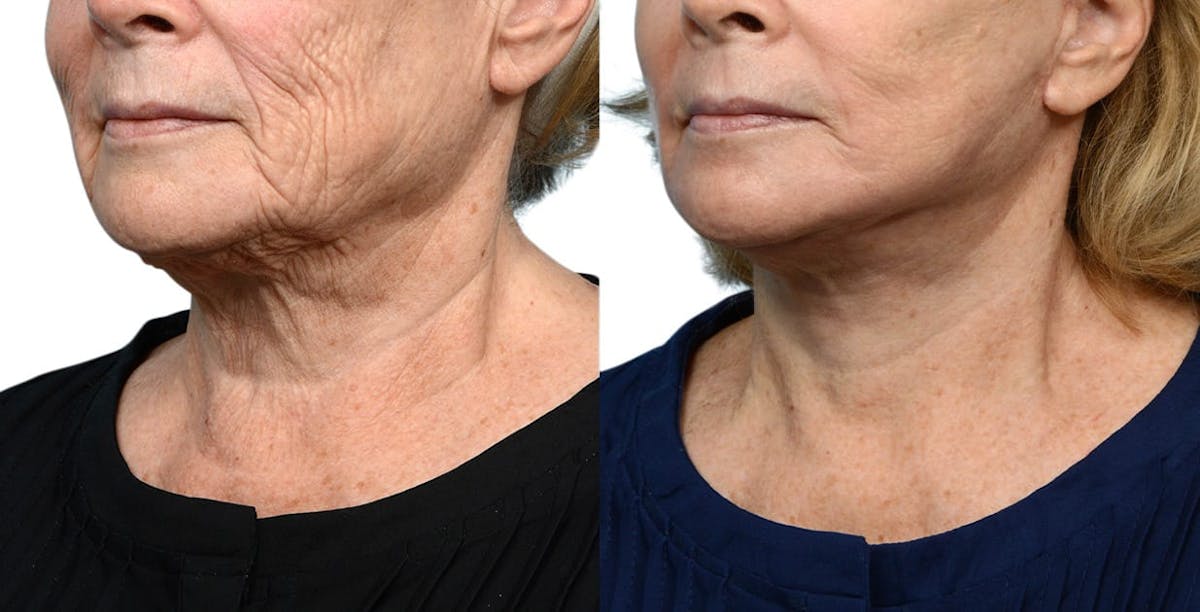 Facelift Before & After Gallery - Patient 129558 - Image 2