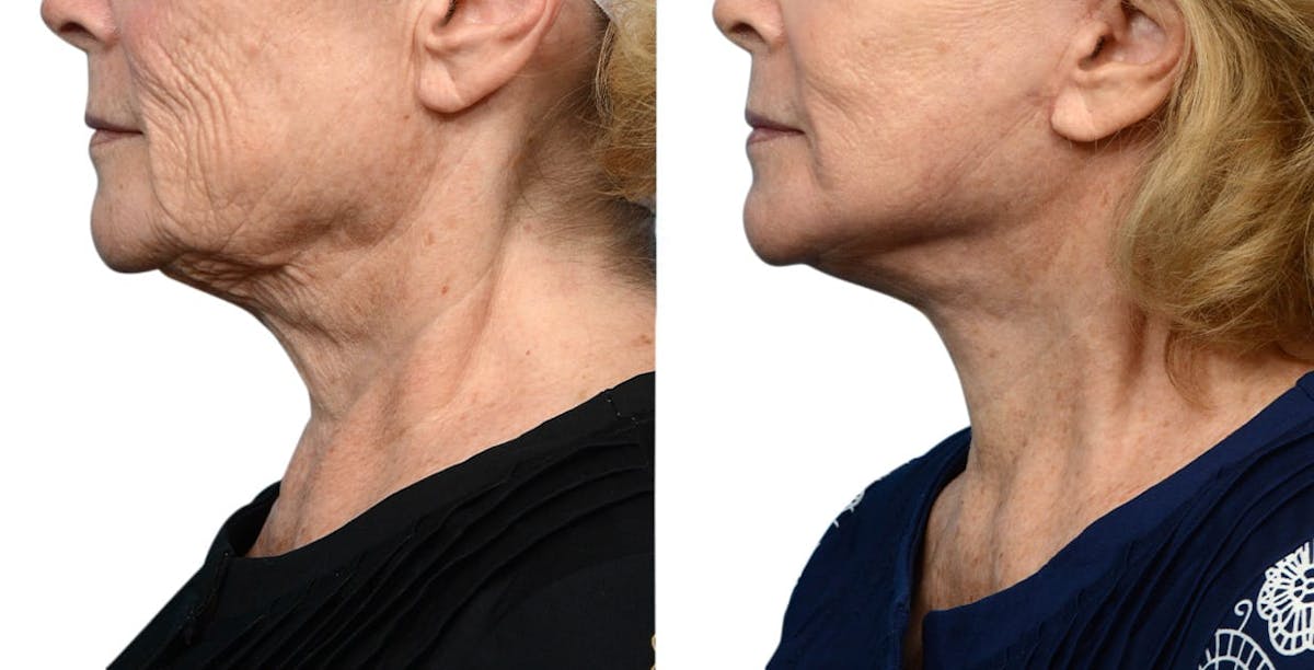 Facelift Before & After Gallery - Patient 129558 - Image 3