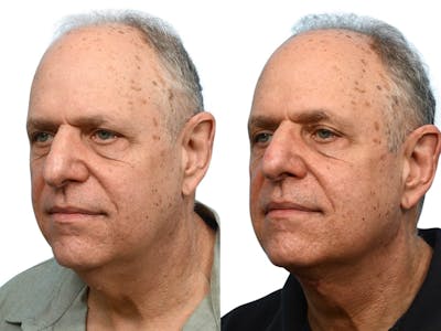 Facelift Before & After Gallery - Patient 108799 - Image 1