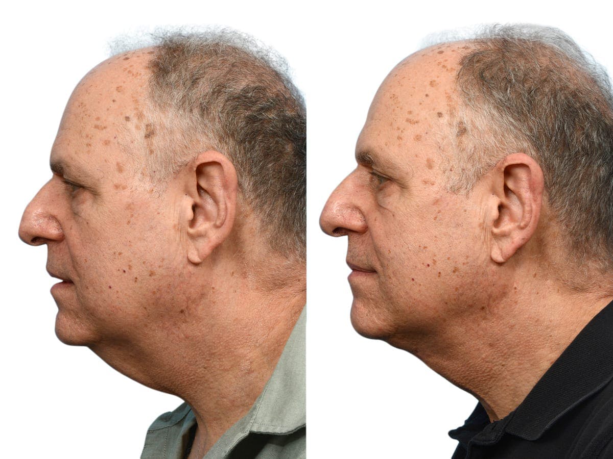 Facelift Before & After Gallery - Patient 108799 - Image 2
