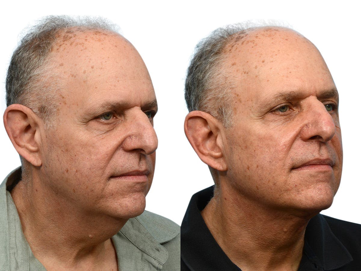 Facelift Before & After Gallery - Patient 108799 - Image 3