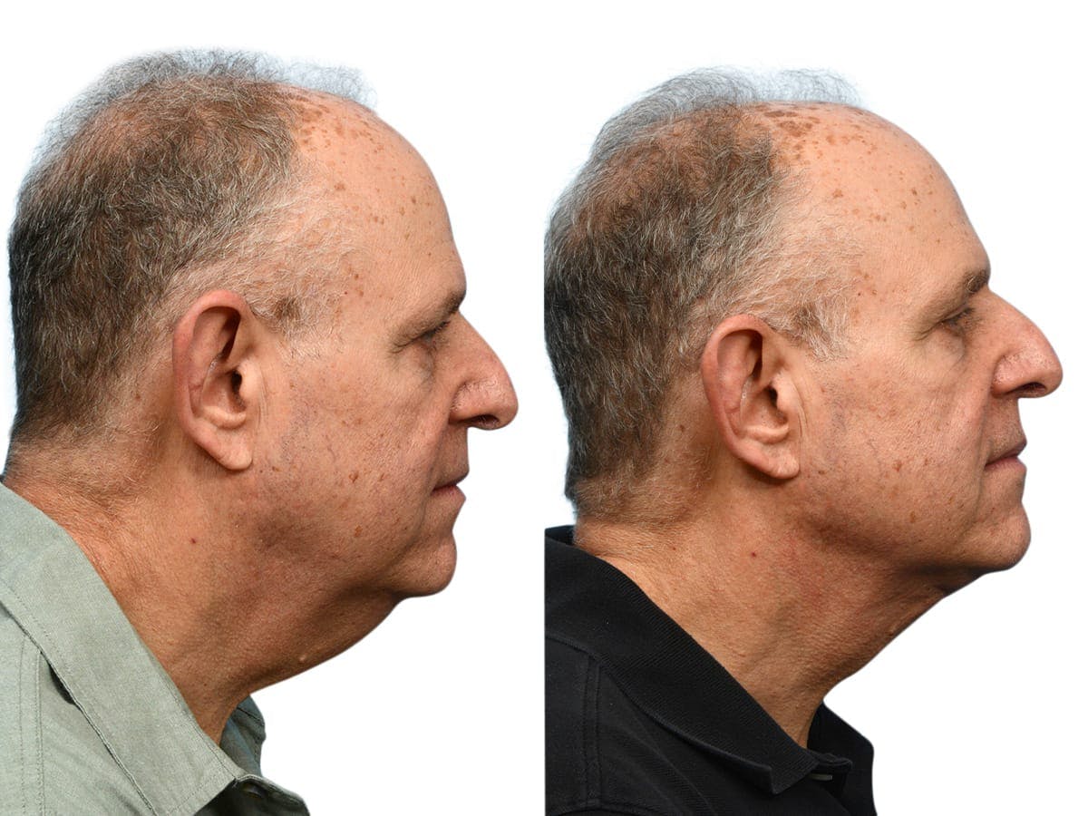 Facelift Before & After Gallery - Patient 108799 - Image 4