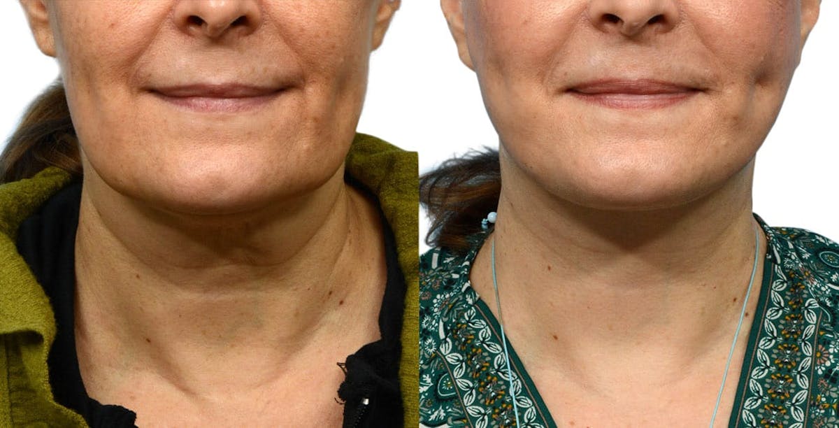 Facelift Before & After Gallery - Patient 224504 - Image 1