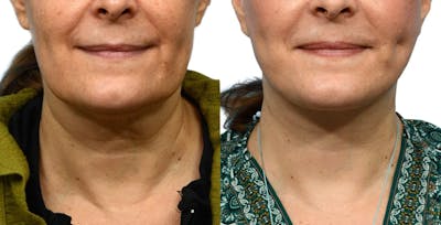 Facelift Before & After Gallery - Patient 224504 - Image 1