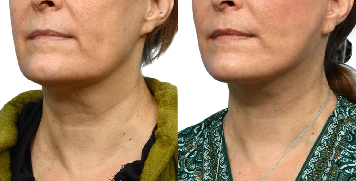 Facelift Before & After Gallery - Patient 224504 - Image 2