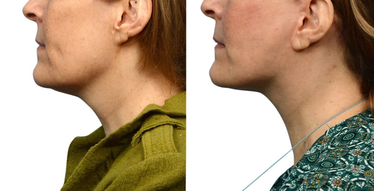 Facelift Before & After Gallery - Patient 224504 - Image 3