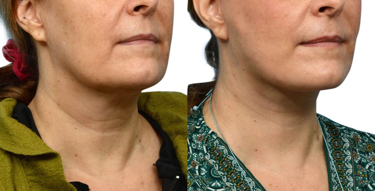 Facelift Before & After Gallery - Patient 224504 - Image 4