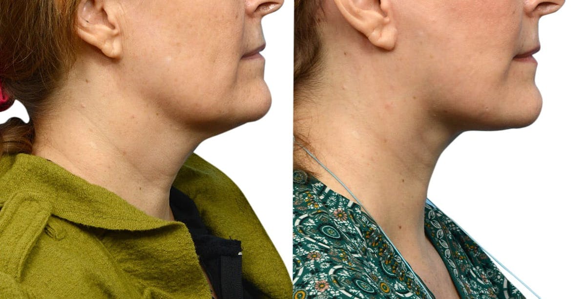 Facelift Before & After Gallery - Patient 224504 - Image 5