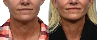 Facelift Before & After Gallery - Patient 216233 - Image 1