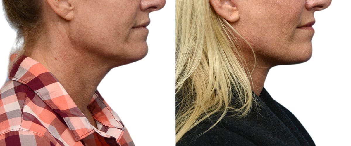 Facelift Before & After Gallery - Patient 216233 - Image 2