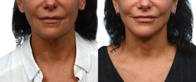 Facelift Before & After Gallery - Patient 742453 - Image 1