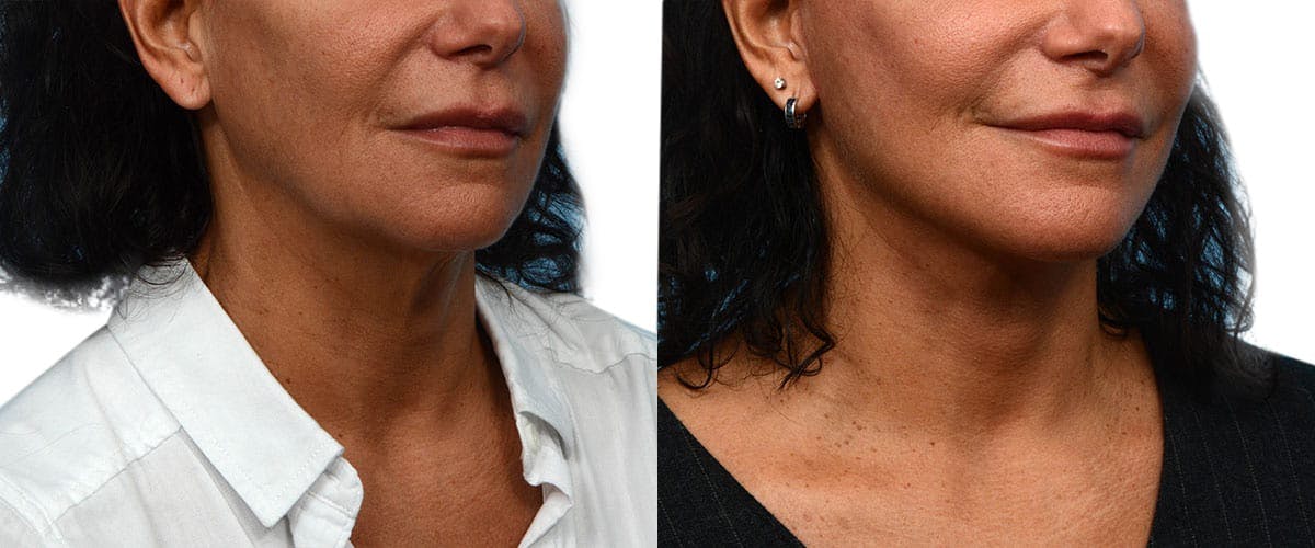 Facelift Before & After Gallery - Patient 742453 - Image 2