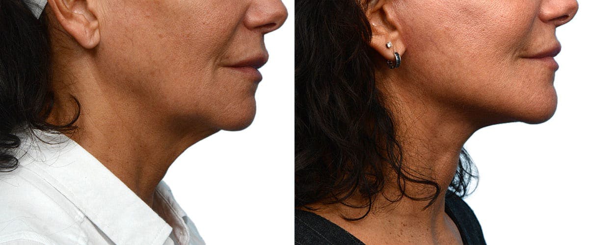 Facelift Before & After Gallery - Patient 742453 - Image 3