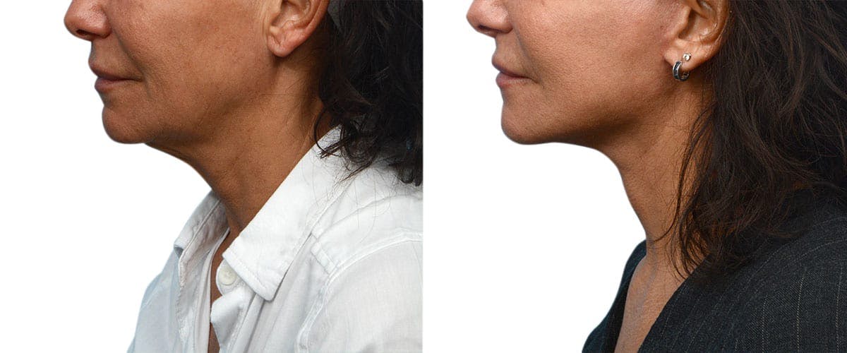 Facelift Before & After Gallery - Patient 742453 - Image 4