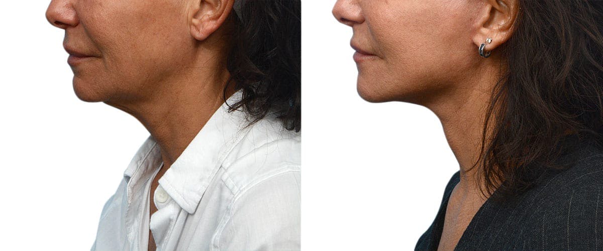 Facelift Before & After Gallery - Patient 742453 - Image 4