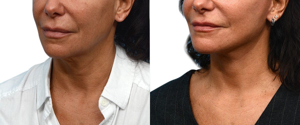 Facelift Before & After Gallery - Patient 742453 - Image 5